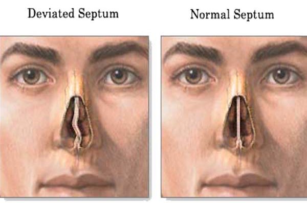 Illustration related to Sinus Polyps — a common sinus condition treated by Charles G. Hurbis, M.D.
