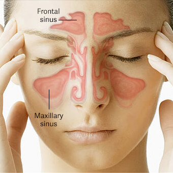 Illustration related to Inferior Turbinate Hypertrophy — a common sinus condition treated by Charles G. Hurbis, M.D.