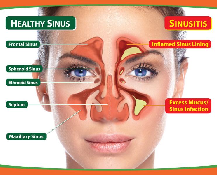 Illustration related to Septal Deviation — a common sinus condition treated by Charles G. Hurbis, M.D.